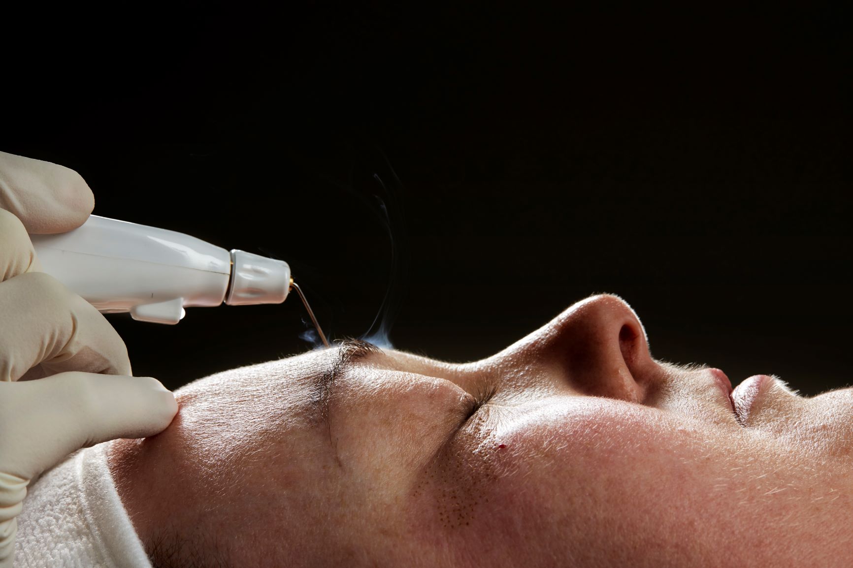 Plasma skin tightening